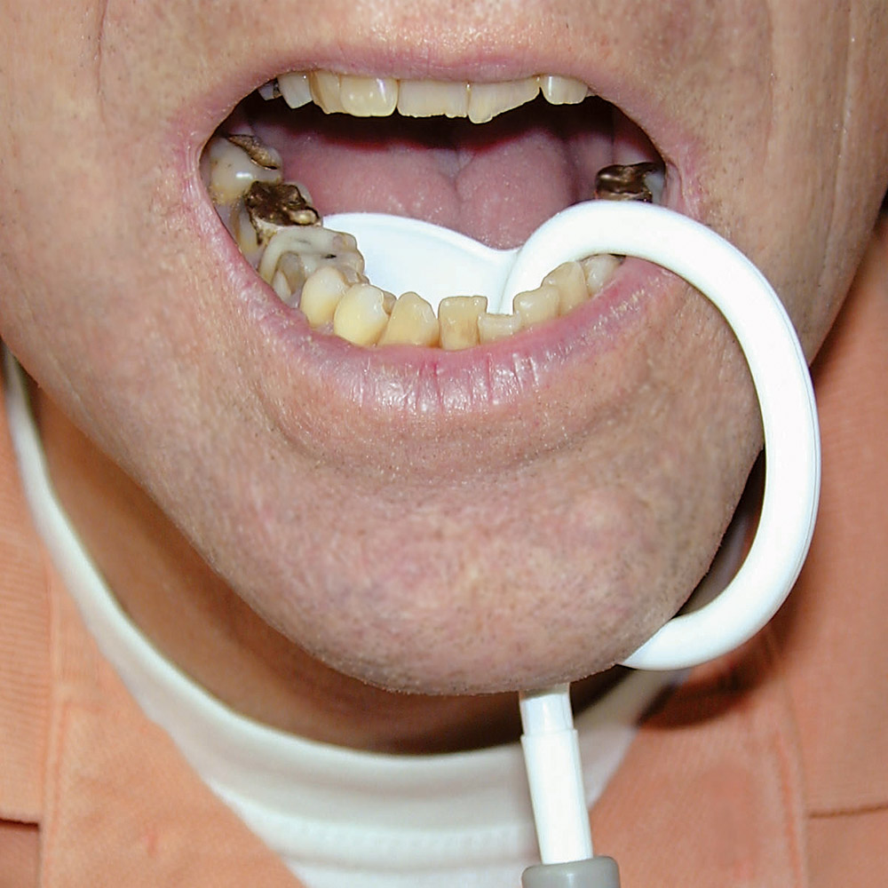 SWE-Flex spytopsuger med tungeholder, 100 stk.